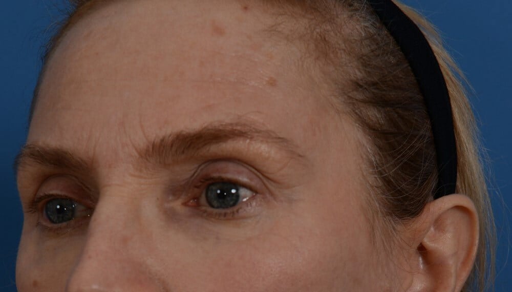 Laser & fat injection Before