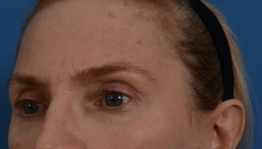 Laser & fat injection Before