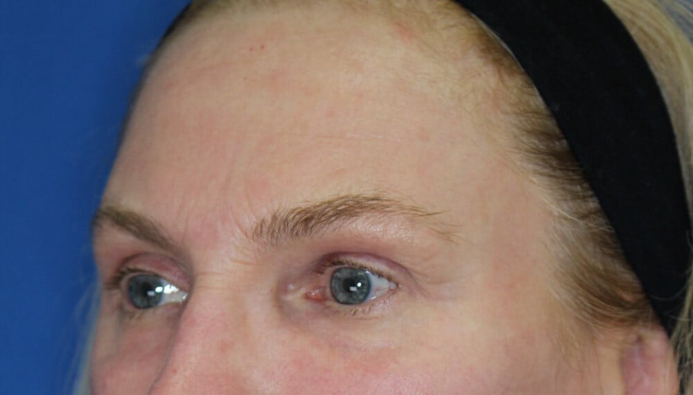 Laser & fat injection After