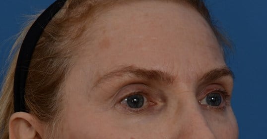 Laser & Fat Injection Before