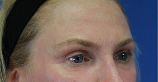 Laser & Fat Injection After