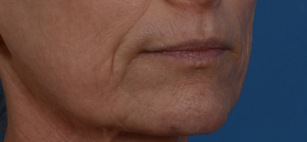 Laser & Fat Injection Before