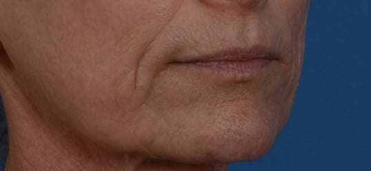 Laser & Fat Injection Before