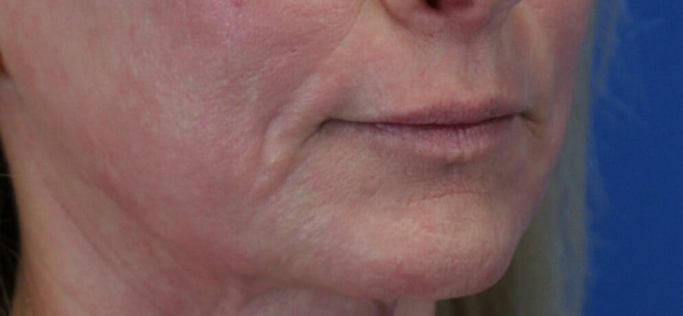 Laser & Fat Injection After