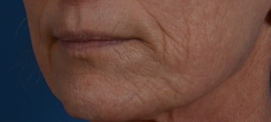 Laser & Fat Injection Before