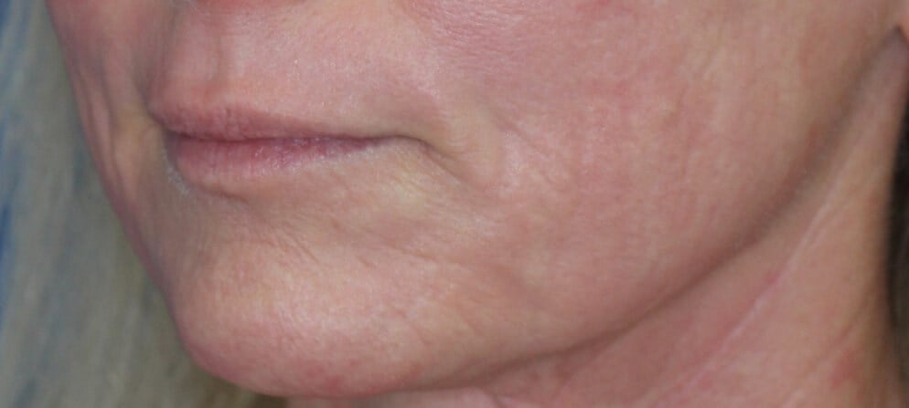 Laser & Fat Injection After