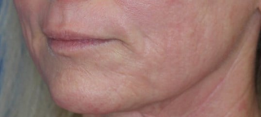 Laser & Fat Injection After