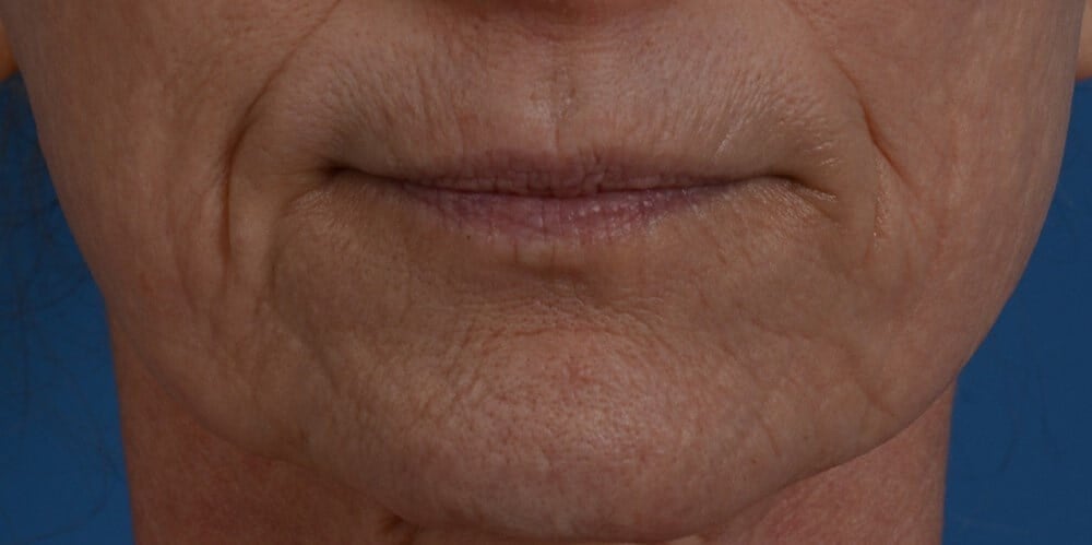 Laser & Fat Injection Before