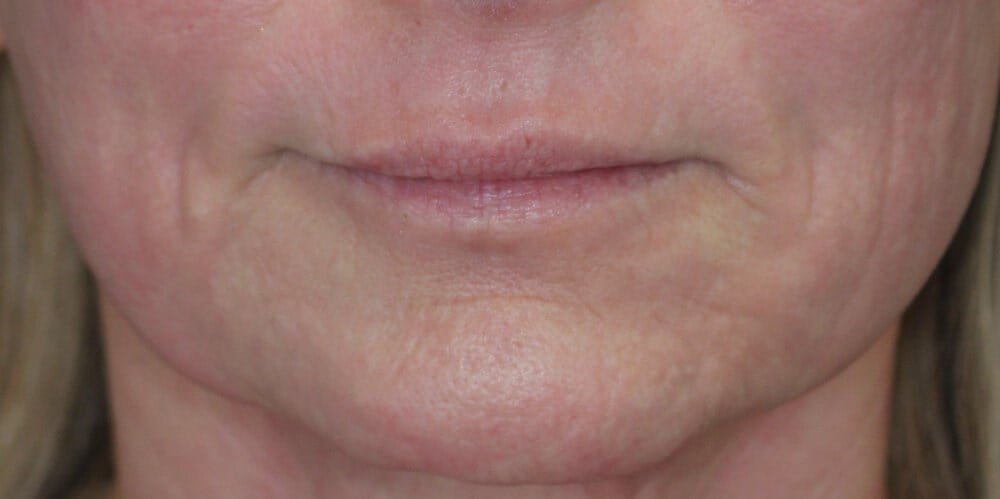 Laser & Fat Injection After