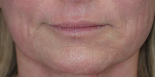 Laser & Fat Injection After