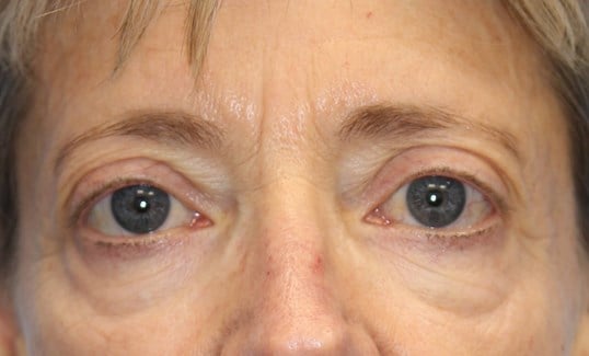 Laser & Fat Injection Before