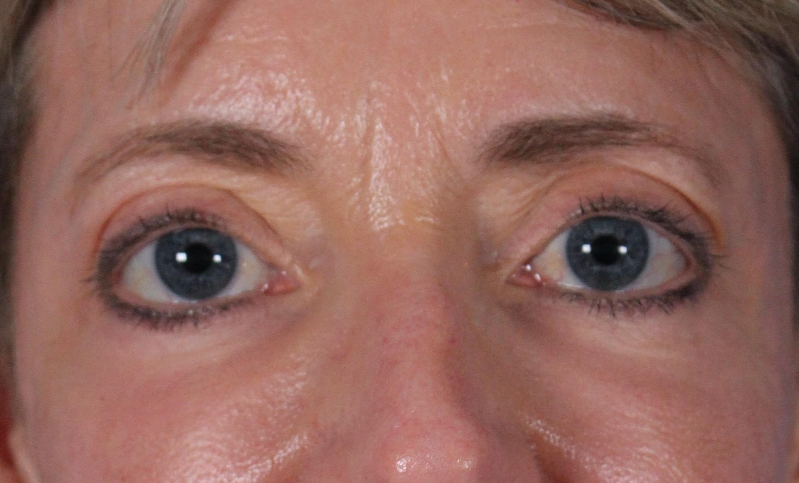 Laser & Fat Injection After