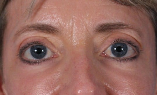 Laser & Fat Injection After