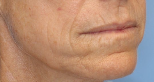 Laser & Fat Injection Before