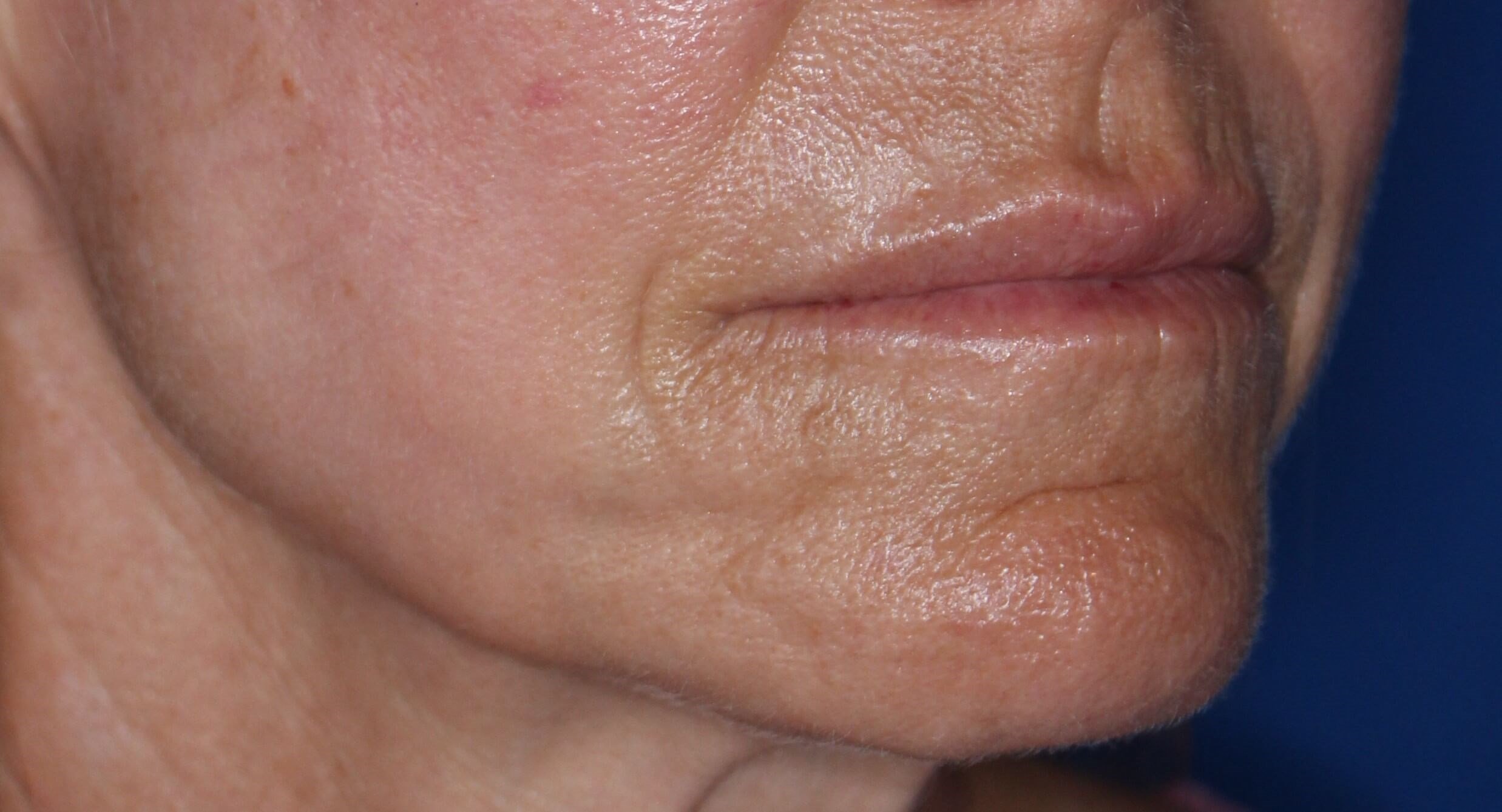 Laser & Fat Injection After