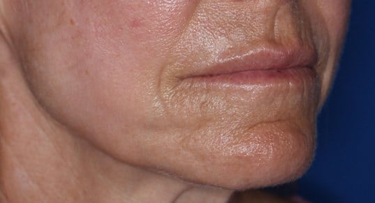 Laser & Fat Injection After