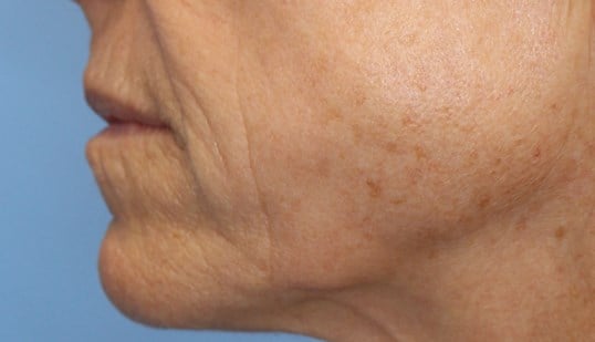 Laser & Fat Injection Before