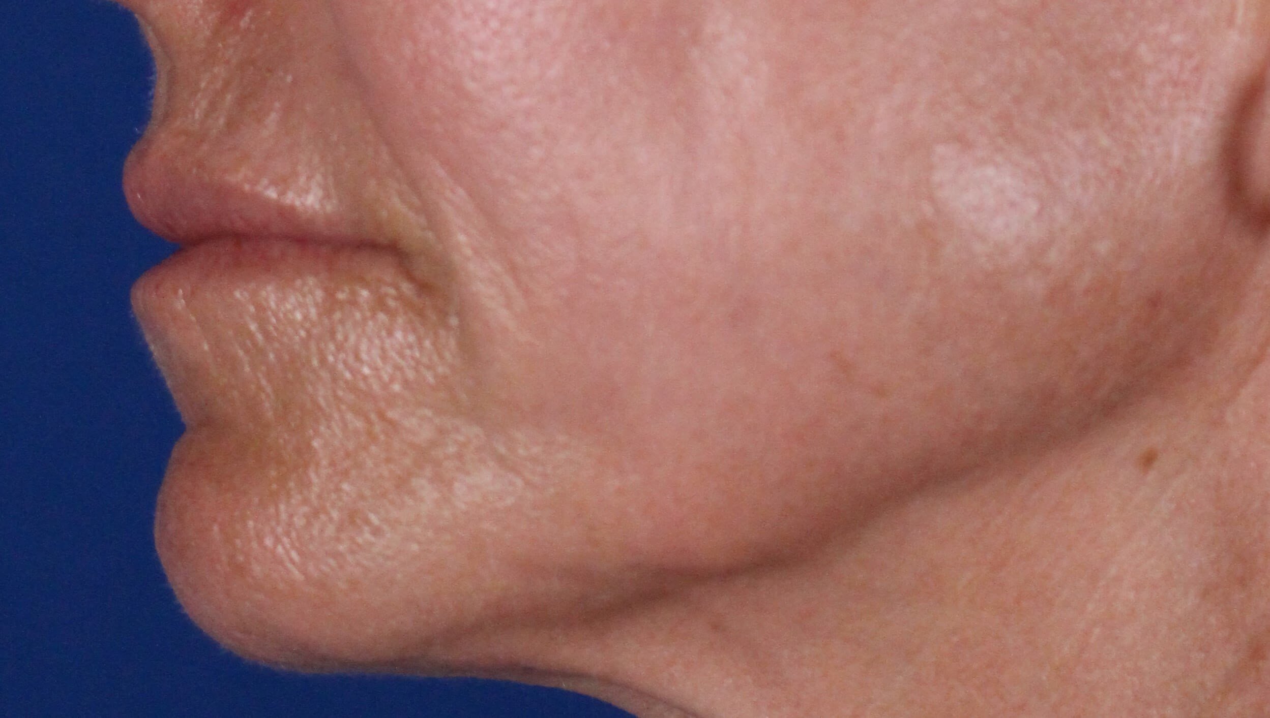 Laser & Fat Injection After