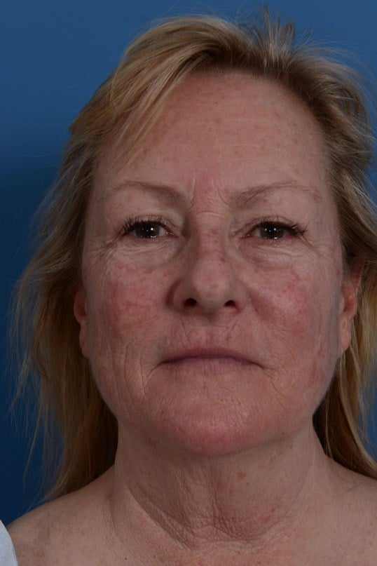 Laser Resurfacing Before