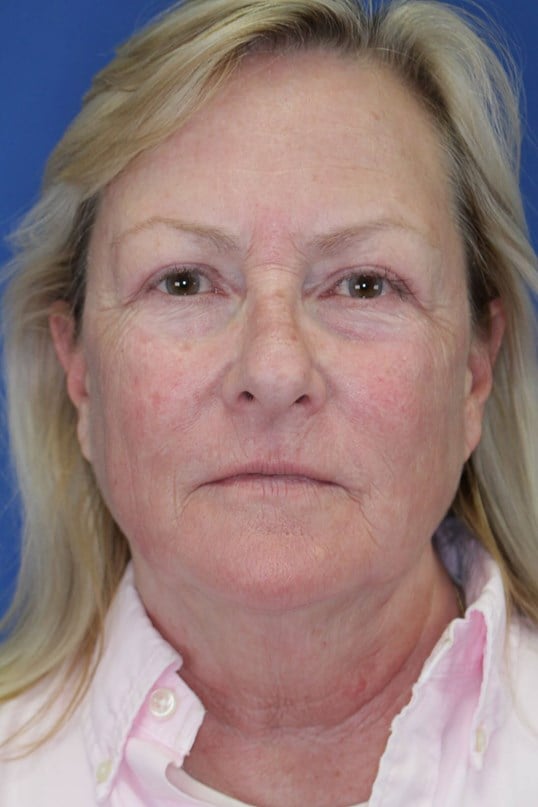 Laser Resurfacing After