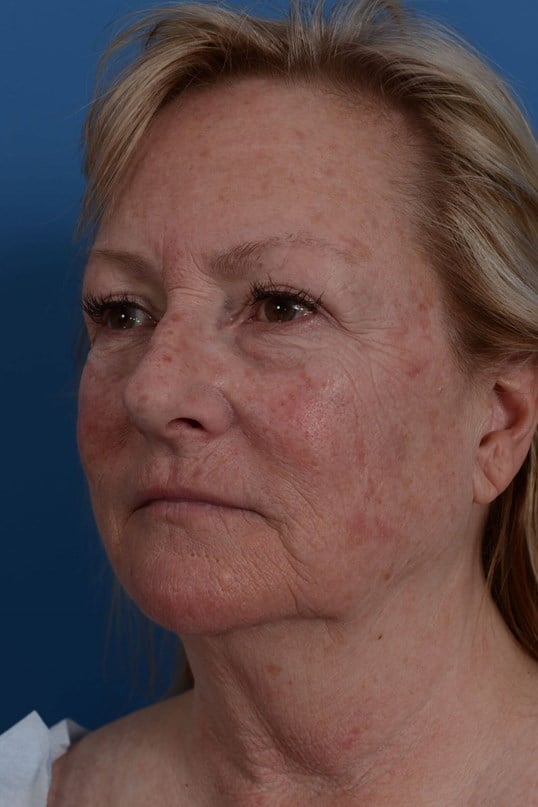 Laser Resurfacing Before