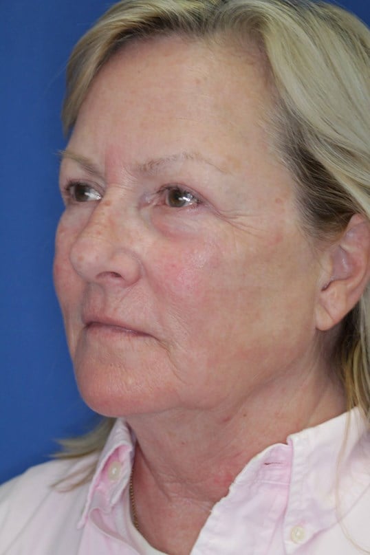 Laser Resurfacing After