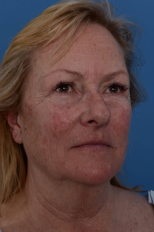 Laser Resurfacing Before