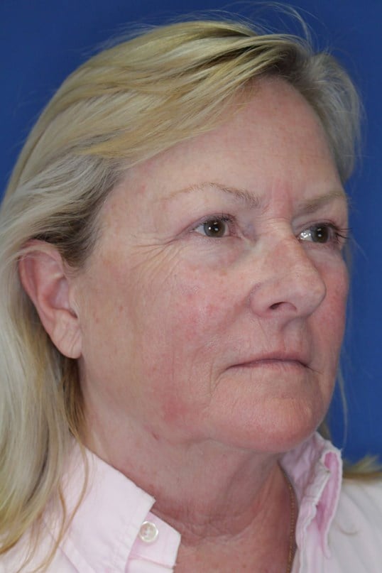 Laser Resurfacing After