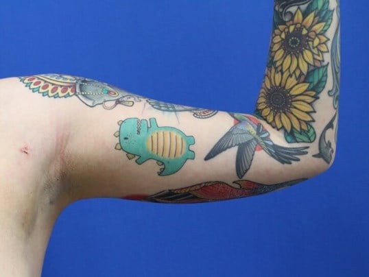 Arm Awake Lipo After