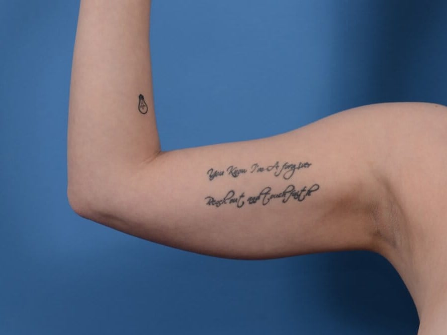 Arm Awake Lipo Before