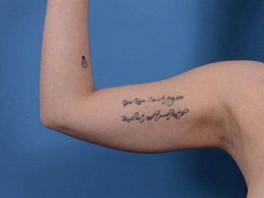 Arm Awake Lipo Before