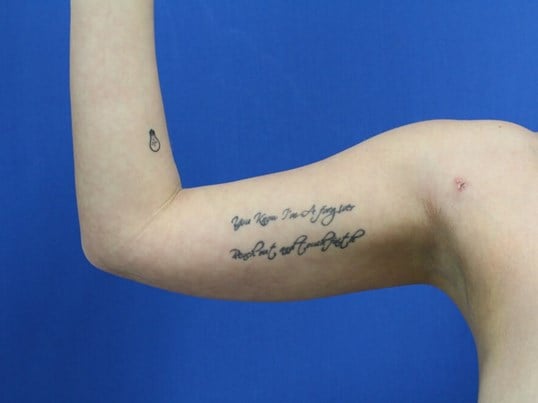 Arm Awake Lipo After