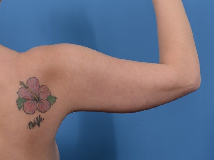 Arm Awake Lipo Before