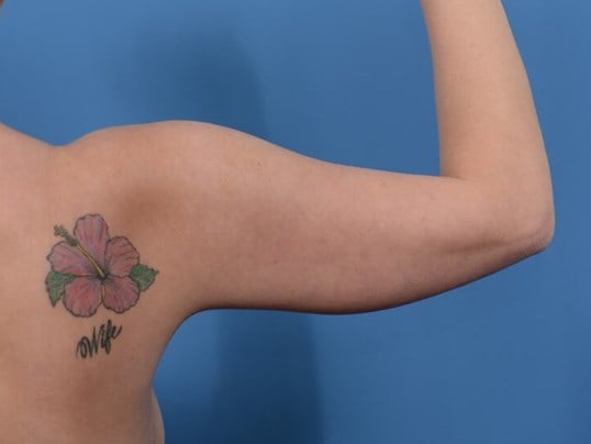 Arm Awake Lipo Before