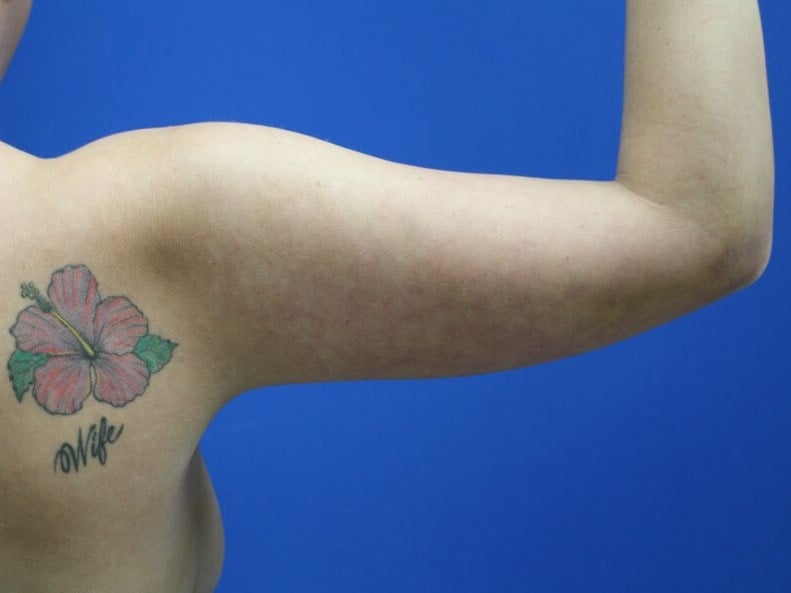 Arm Awake Lipo After