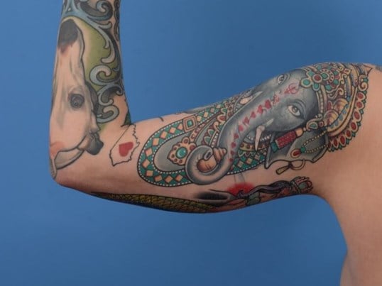 Arm Awake Lipo Before