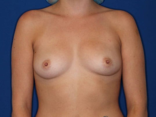 375 Silicone Implants Before