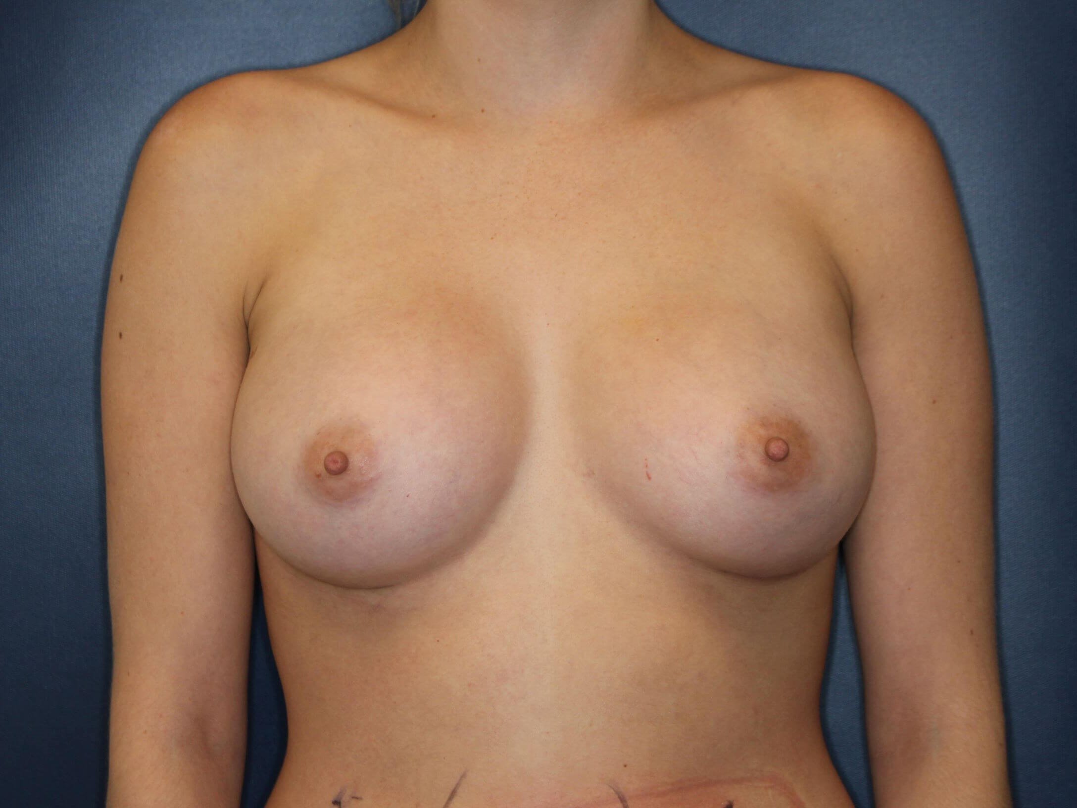 375 Silicone Implants After