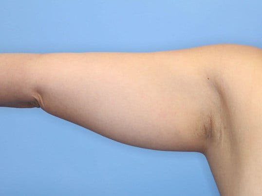 Awake Liposuction Arms Before