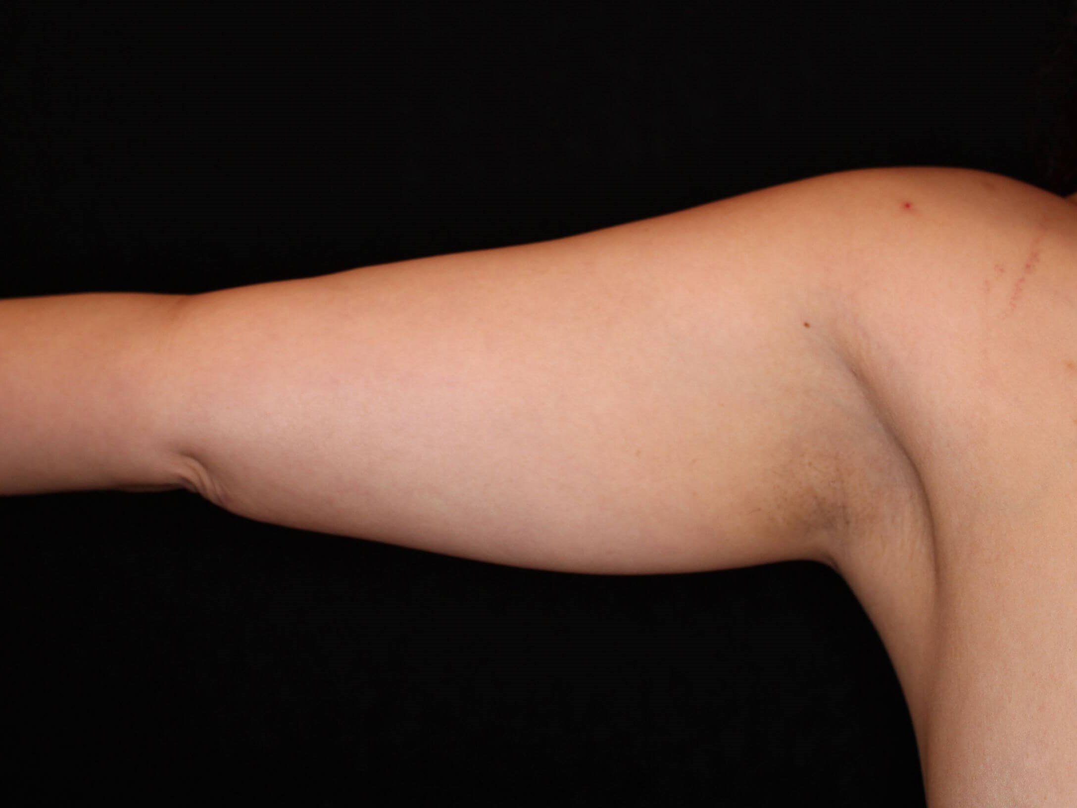 Awake Liposuction Arms After