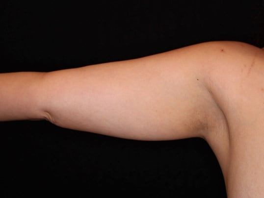 Awake Liposuction Arms After