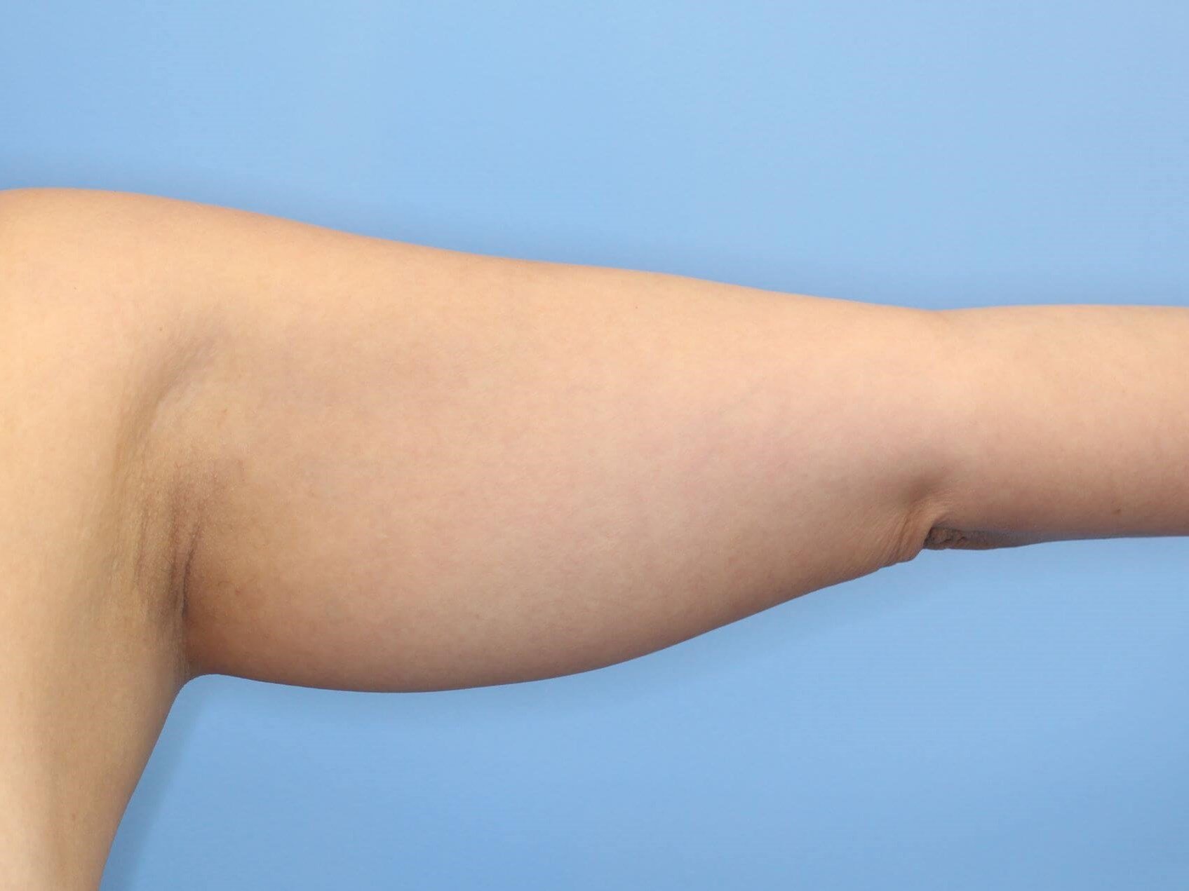 Awake Liposuction Arms Before