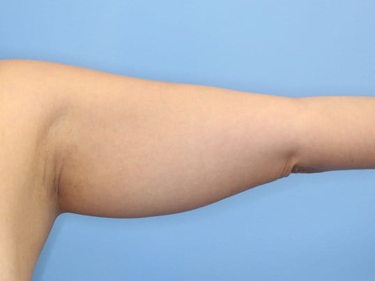 Awake Liposuction Arms Before