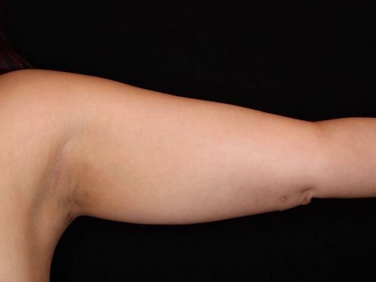 Awake Liposuction Arms After