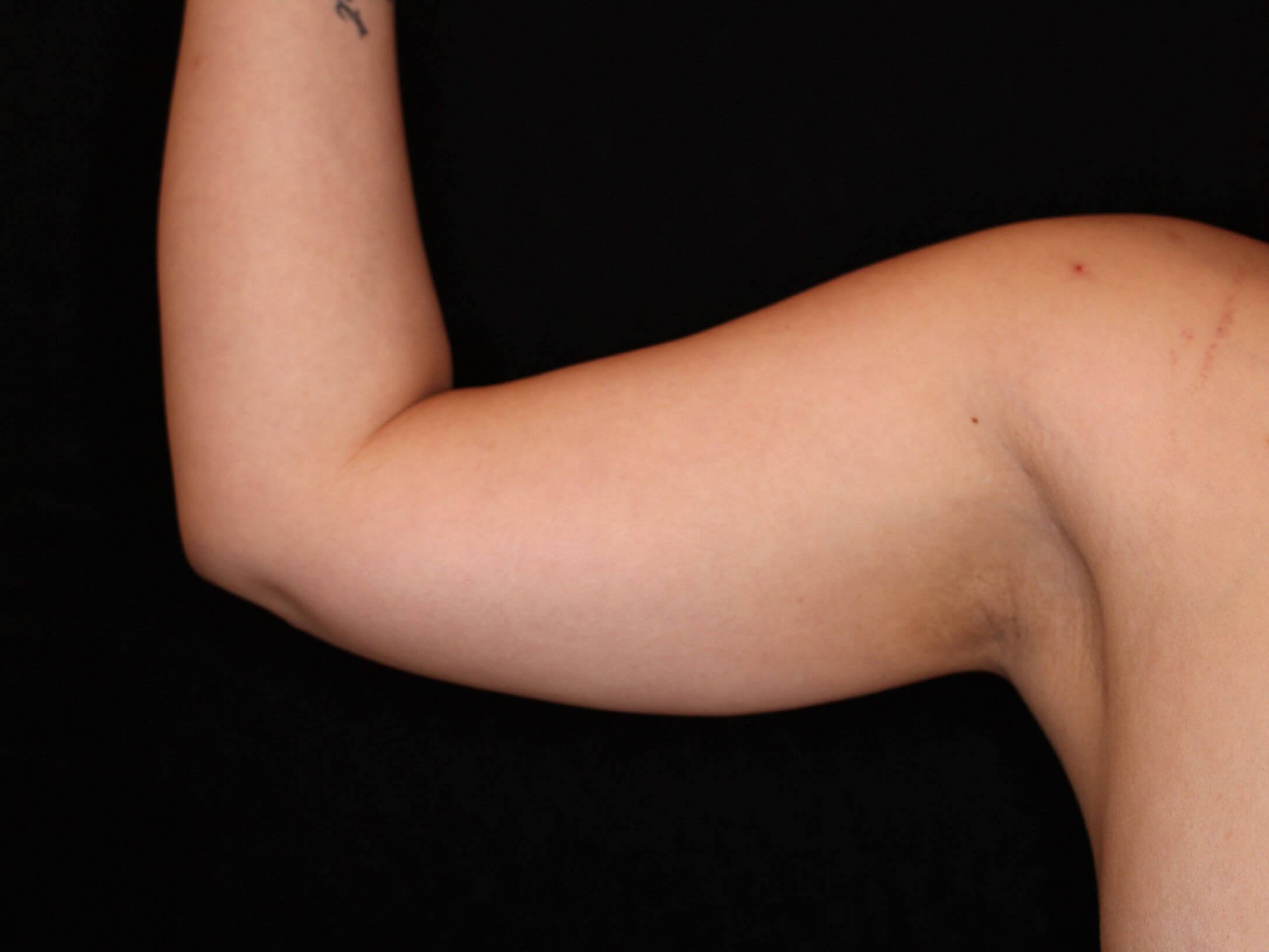 Awake Liposuction Arms After