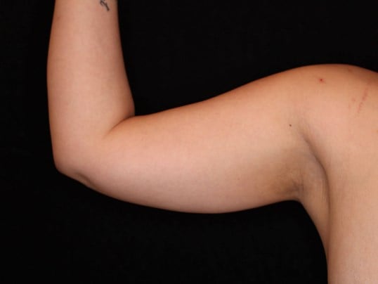 Awake Liposuction Arms After