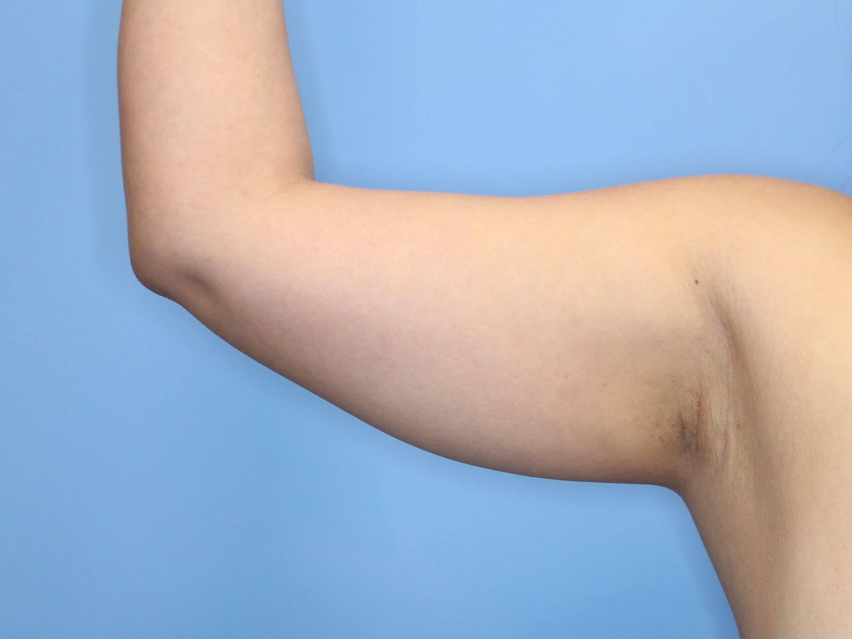 Awake Liposuction Arms Before