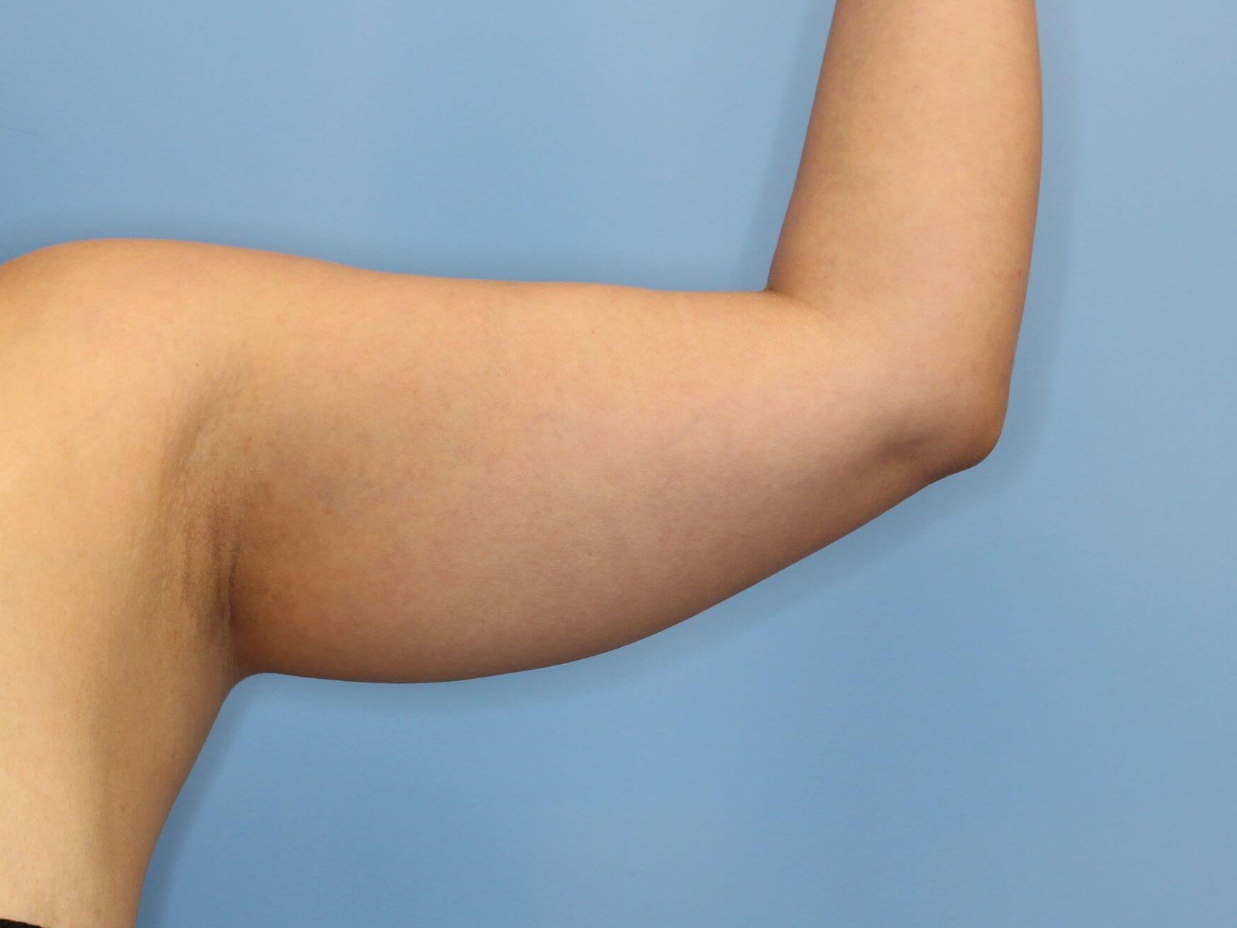 Awake Liposuction Arms Before