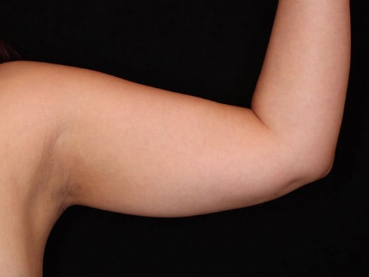 Awake Liposuction Arms After