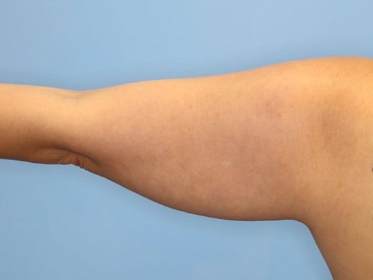 Awake Liposuction Arms Before